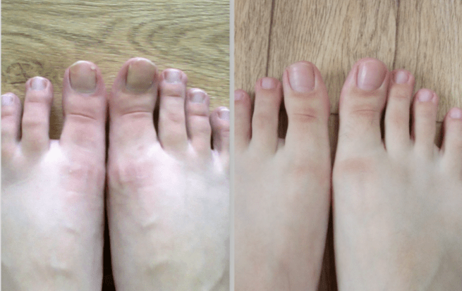 before and after nail fungus treatment