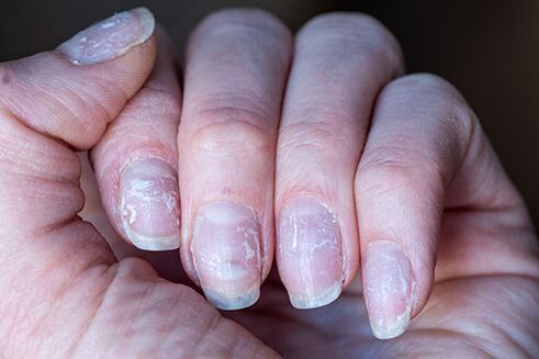 nail fungus