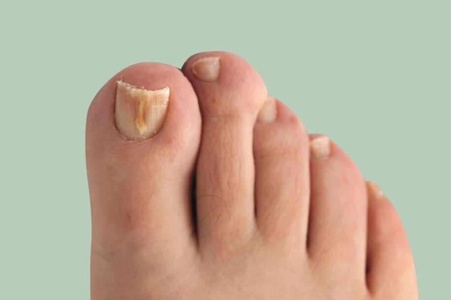 Symptoms of nail fungus