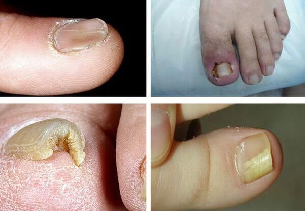 What do nail fungus look like 