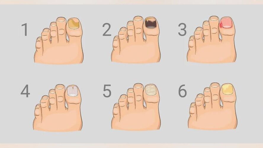 The main signs of athlete's foot