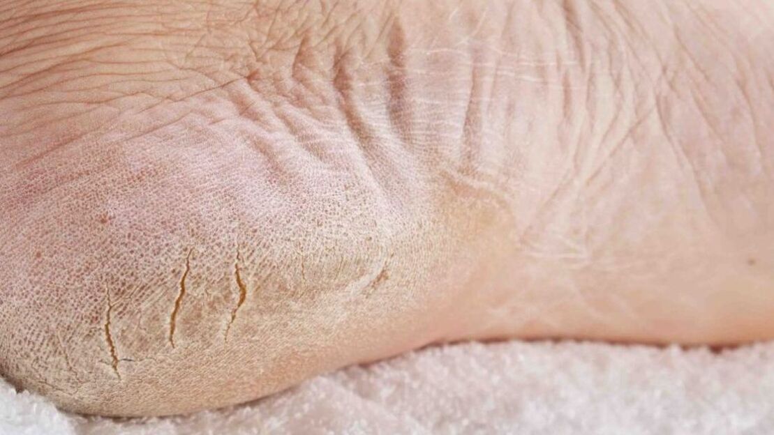 fungal infection of the foot