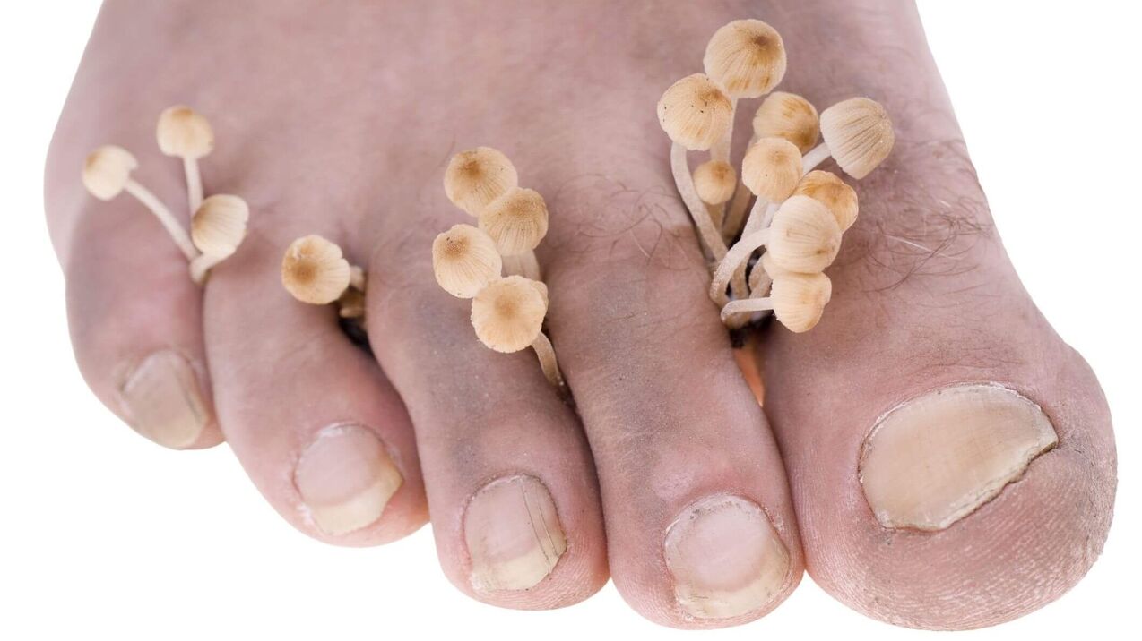 human athlete's foot fungal infection