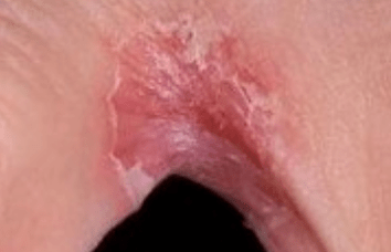 The fungus in the legs between the fingers