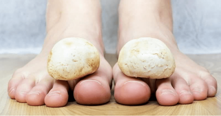 Quick Home Mushroom Treatment at Home