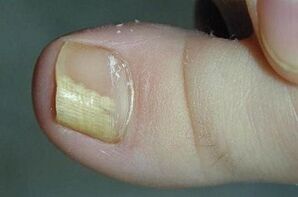 Reasons for appearing the fungus on the big toe