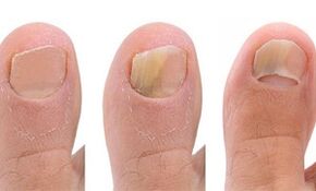 Stages of fungal development on the big toe