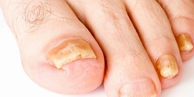 As well as how to cure nail fungus