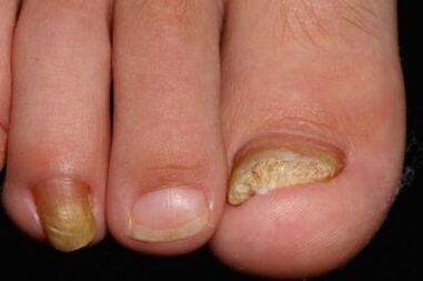 Myth of nails on the feet