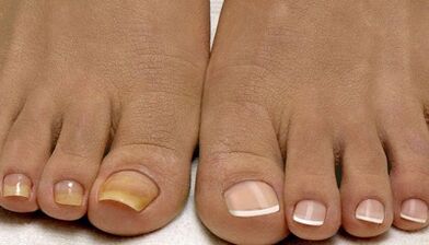 Causes of fungi appearance on nails