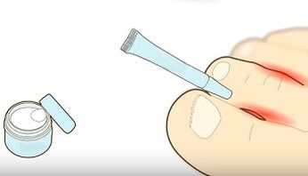 How to treat fungi on your fingers