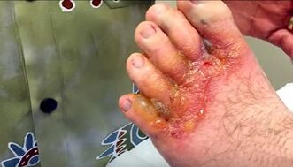 Symptoms of fungi on the fingers