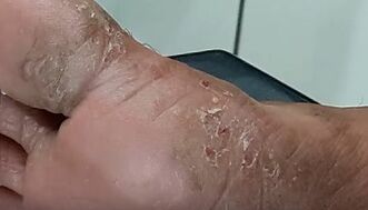 Types and forms of fungi on the fingers