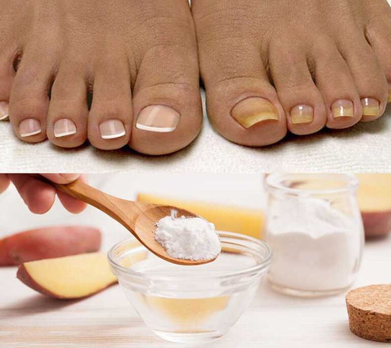 Soda for treating nail fungus
