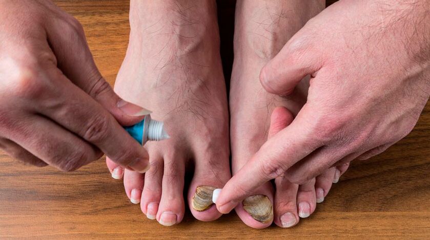 Application of antifungal cream to toenails to treat onychomycosis